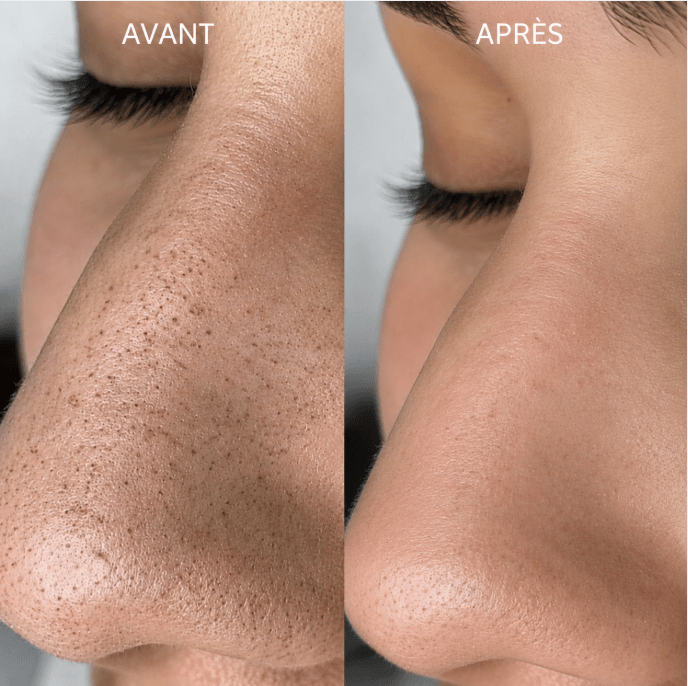 Exfoliant Coréen Peel Shot