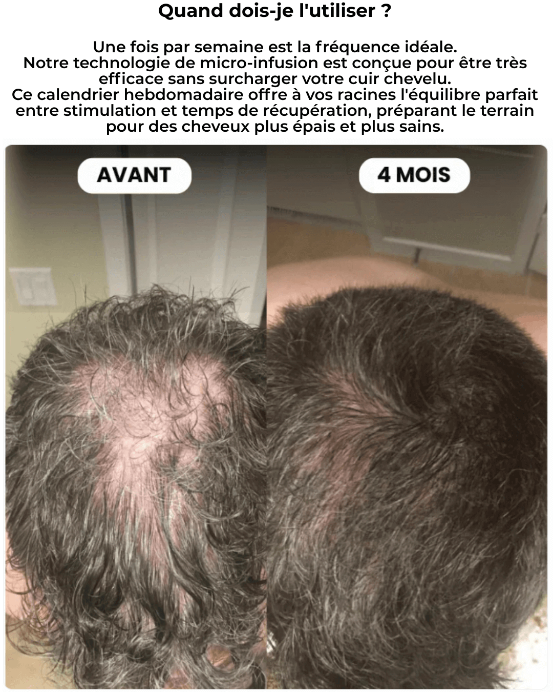 Mazenzo Micro Infuse - Hair Growth Activator