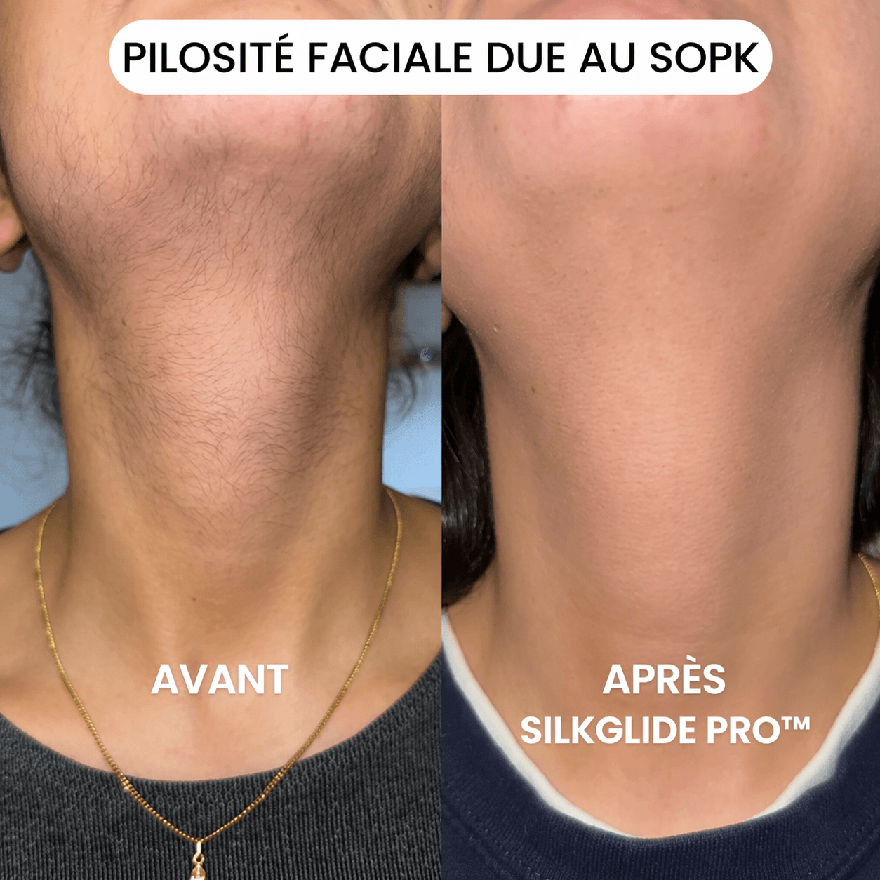 Mazenzo SilkGlide Pro™ – Épilateur visage 2-en-1